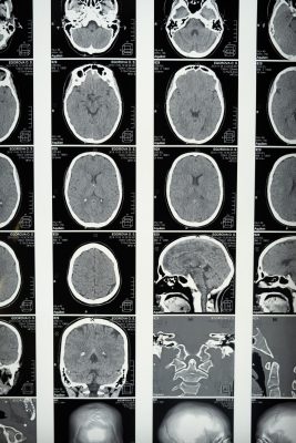 How traumatic brain injuries are treated